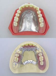 金属床義歯（薄く強度に優れた義歯）