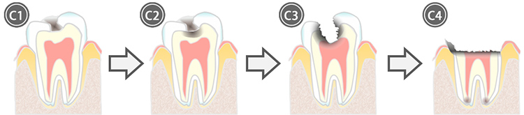 虫歯治療について
