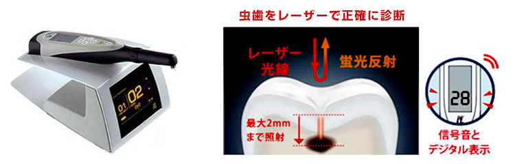 虫歯治療について