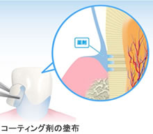 コーティング剤の塗布