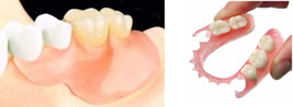 ノンクラスプデンチャー（金属のバネを使わない入れ歯）