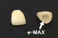 セラミッククラウン（e-MAX）